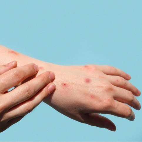 Malattie sessualmente trasmesse